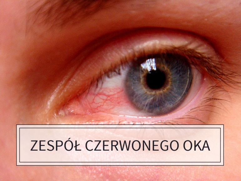 zespół czerwonego oka